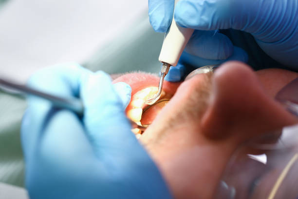 Best Emergency Dental Care for Abscessed Tooth in West Monroe, MI